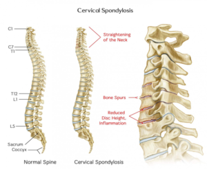 Cervical Spondylosis Treatment In Hanumangarh