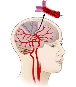 Stroke Treatment In Hanumangarh