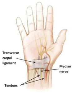 Carpal Tunnel Syndrome Treatment In Hanumangarh
