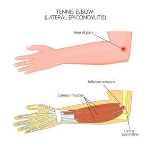 Tennis Elbow Treatment In Hanumangarh