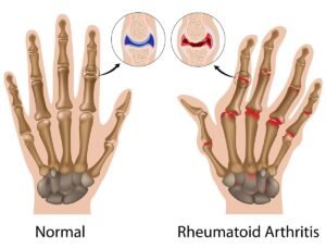 Rheumatoid Arthritis Treatment In Hanumangarh