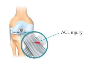 ACL Injury Treatment In Hanumangarh
