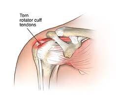 Rotator Cuff Injury Treatment In Hanumangarh