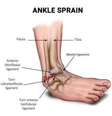 Sprained Ankle Treatment In Hanumangarh